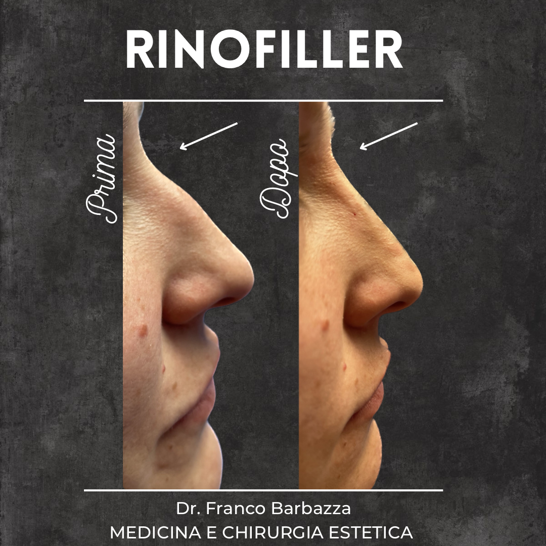 Rinofiller